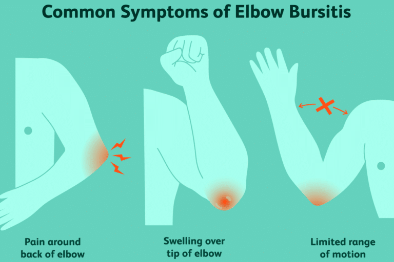 Think You Have Golfer’s Elbow? Here are the Symptoms and What You Can